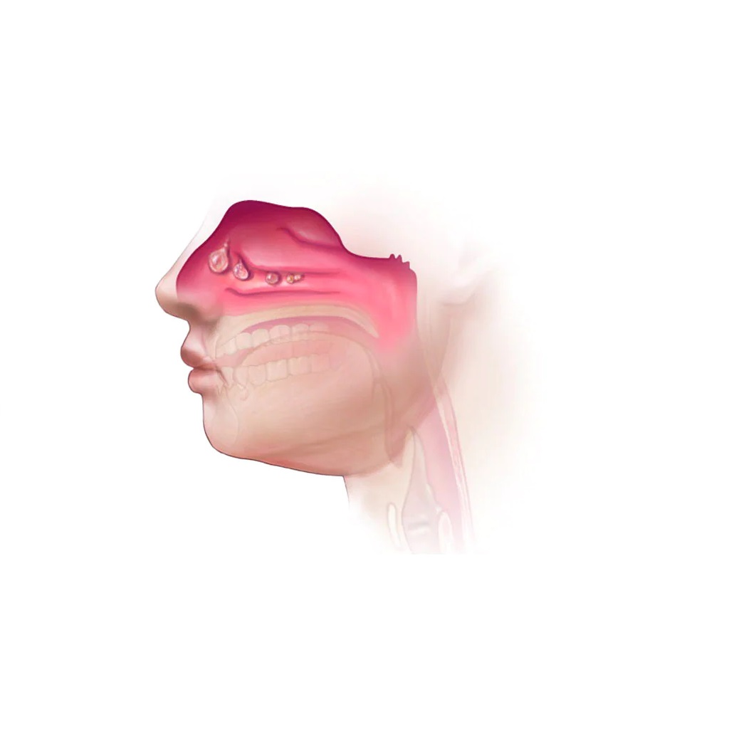 How To Identify And Treat Nasal Polyps