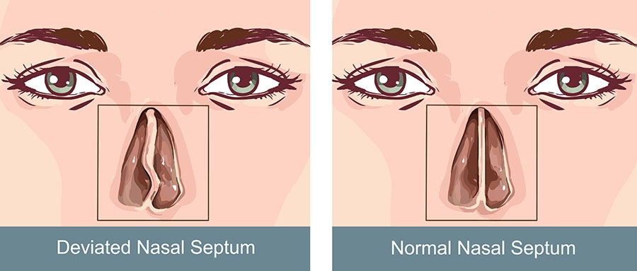 Recognising And Managing Deviated Septum Symptoms