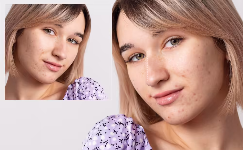 Nose Acne: Causes, Meaning, and Effective Solutions for Clear Skin
