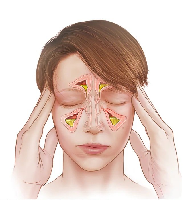 Sinusitis sinus infection