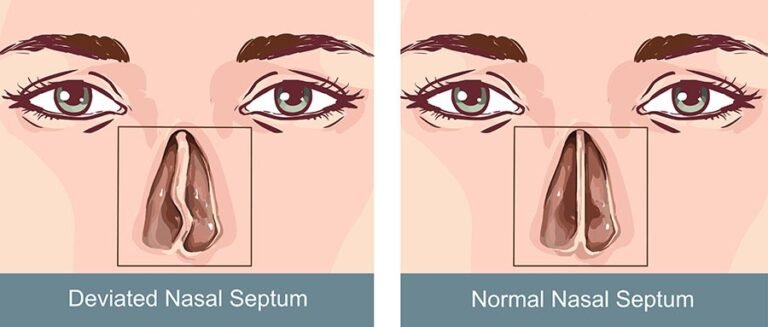 Deviated Septum