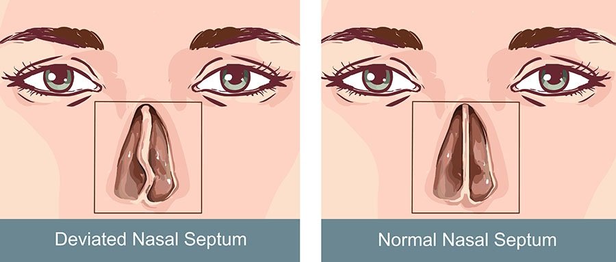 Deviated Septum